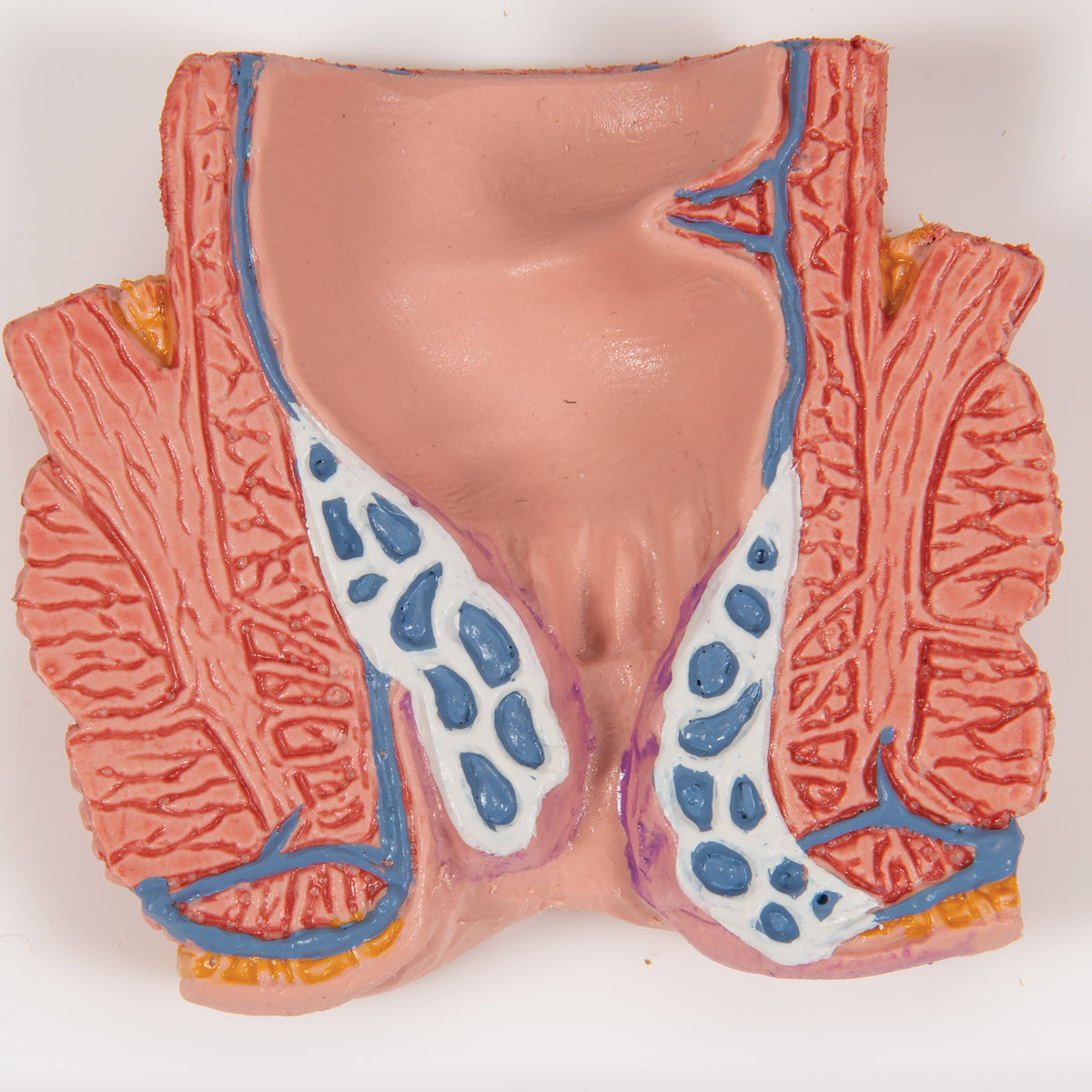 Model af endetarmen som viser hæmorider
