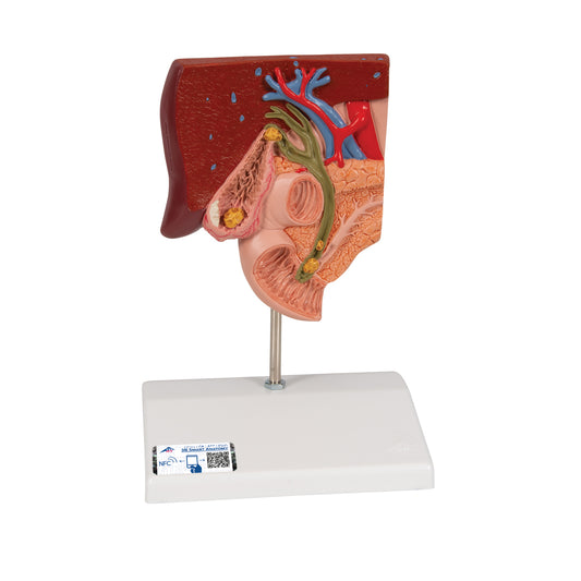 Reduced scale model of the biliary tract showing gall bladder and gallstones