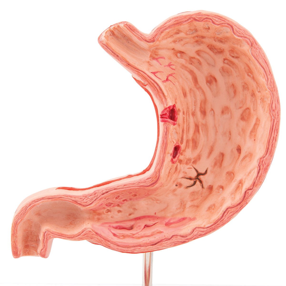 Reduced and detailed model of the stomach showing inflammation and ulcers