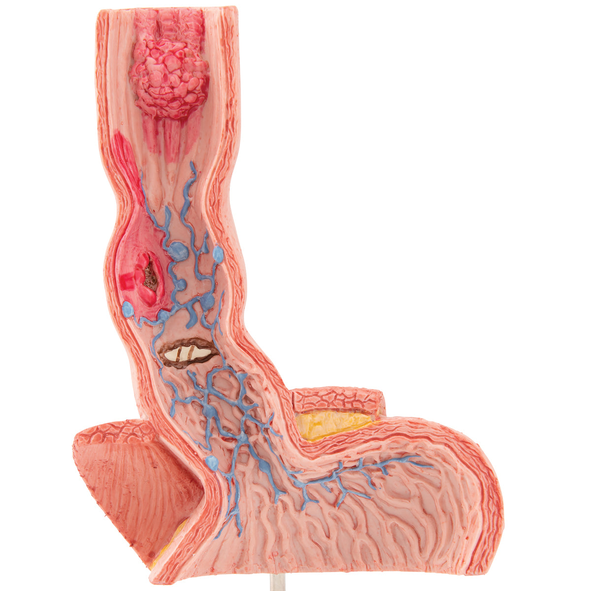 Model showing the esophagus and a bit of the inside of the stomach with various diseases