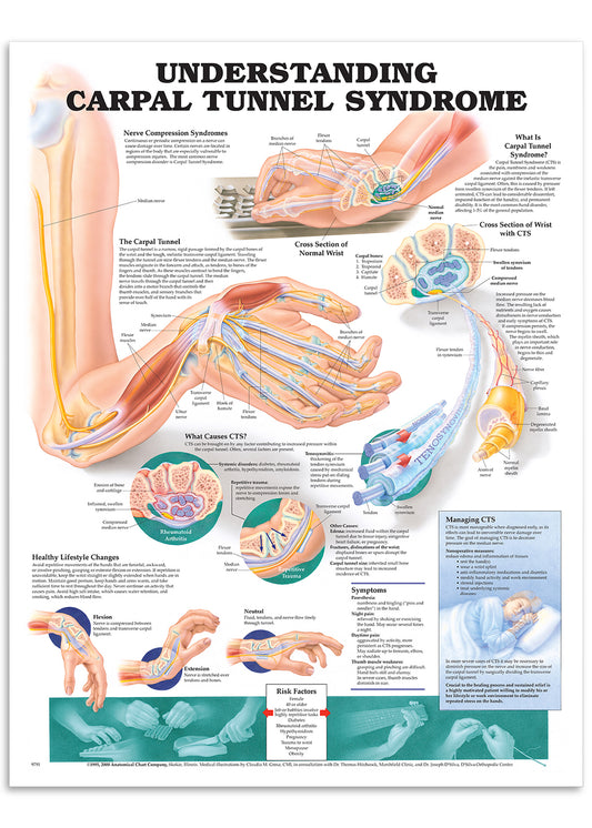 Poster about carpal tunnel syndrome (KTS) in English