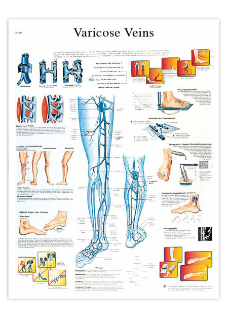 Laminated poster about varicose veins in English 
