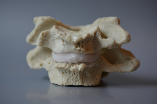 Dynamic spine model of 2 cervical vertebrae showing different consequences of degeneration 