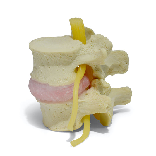 Dynamic spine model of 2 lumbar vertebrae showing a herniated disc. Standard model