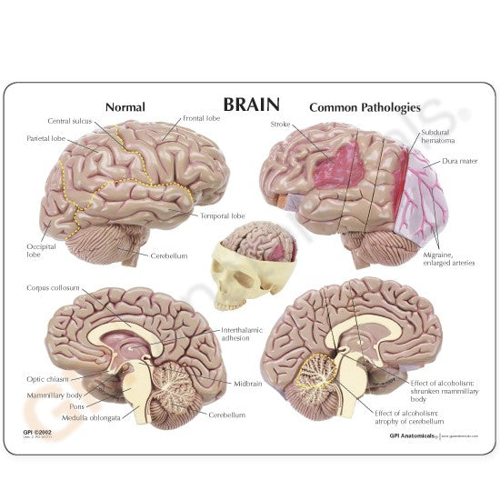 Hjärnmodell med synliga hjärnskador