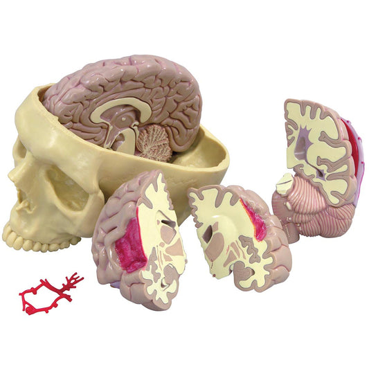 Brain model with visible brain damage