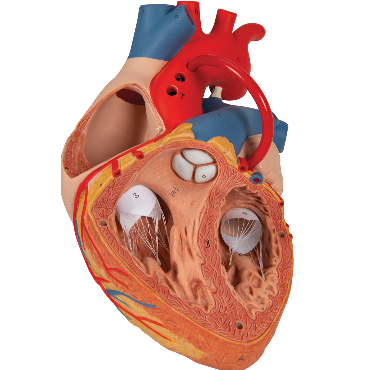 Enlarged heart model showing the result after bypass surgery
