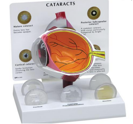 Eye model illustrating cataract, also called cataract