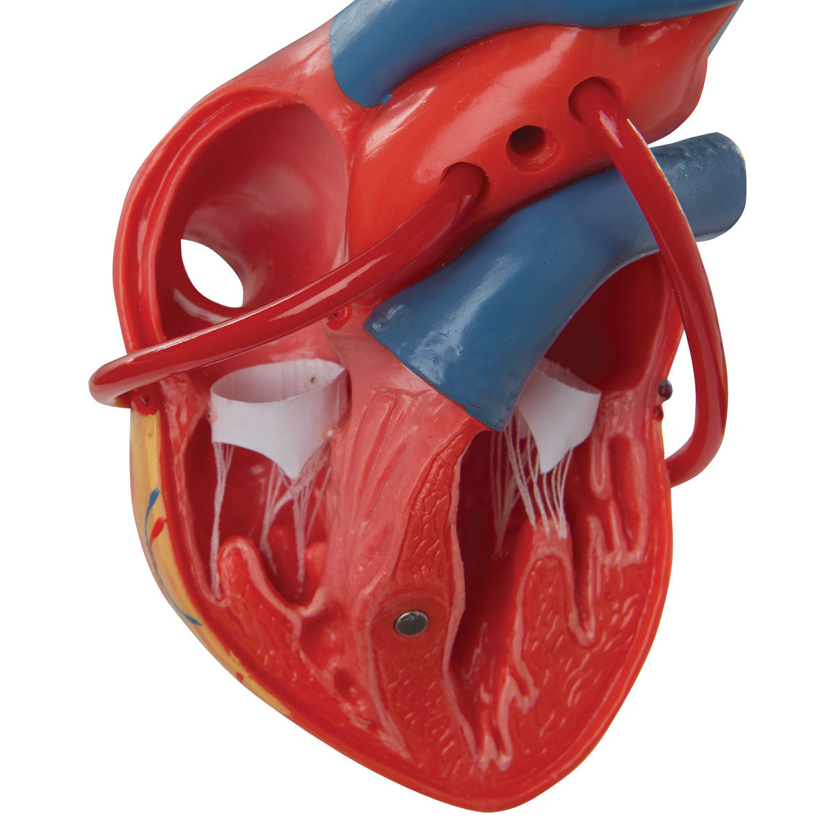 Heart model showing the result after a bypass operation