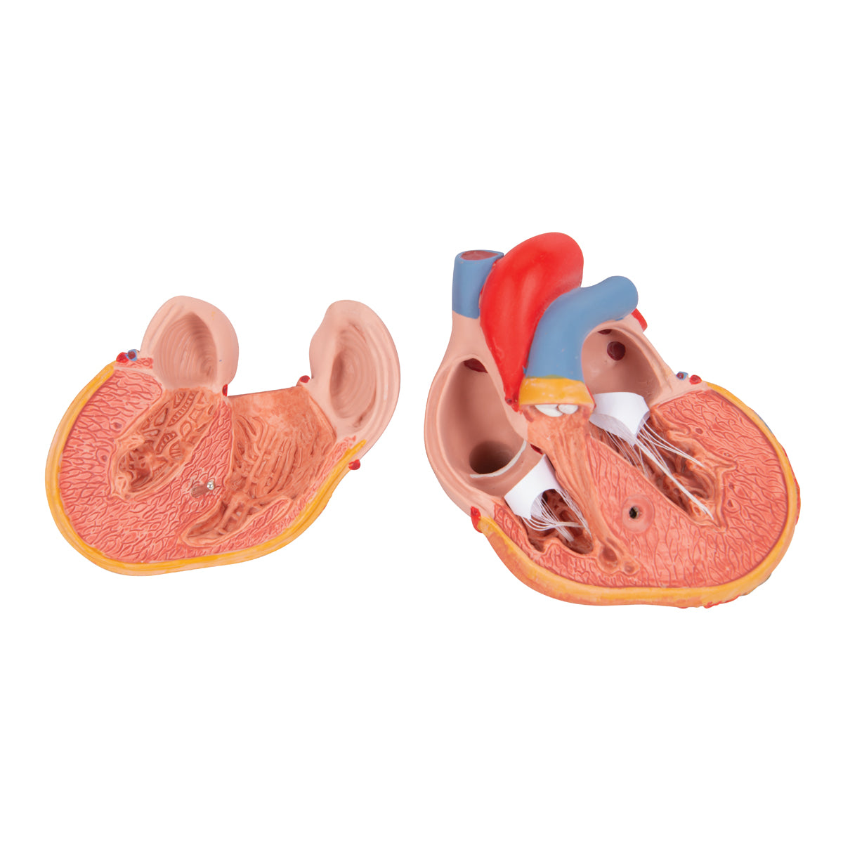 Formindsket hjertemodel med venstre ventrikulær hypertrofi og belastning