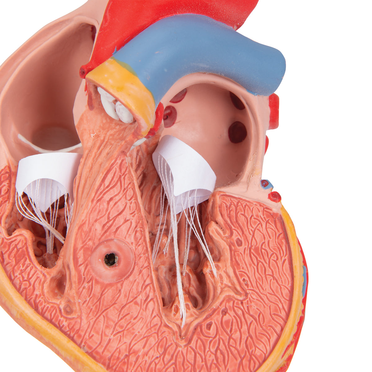 Formindsket hjertemodel med venstre ventrikulær hypertrofi og belastning