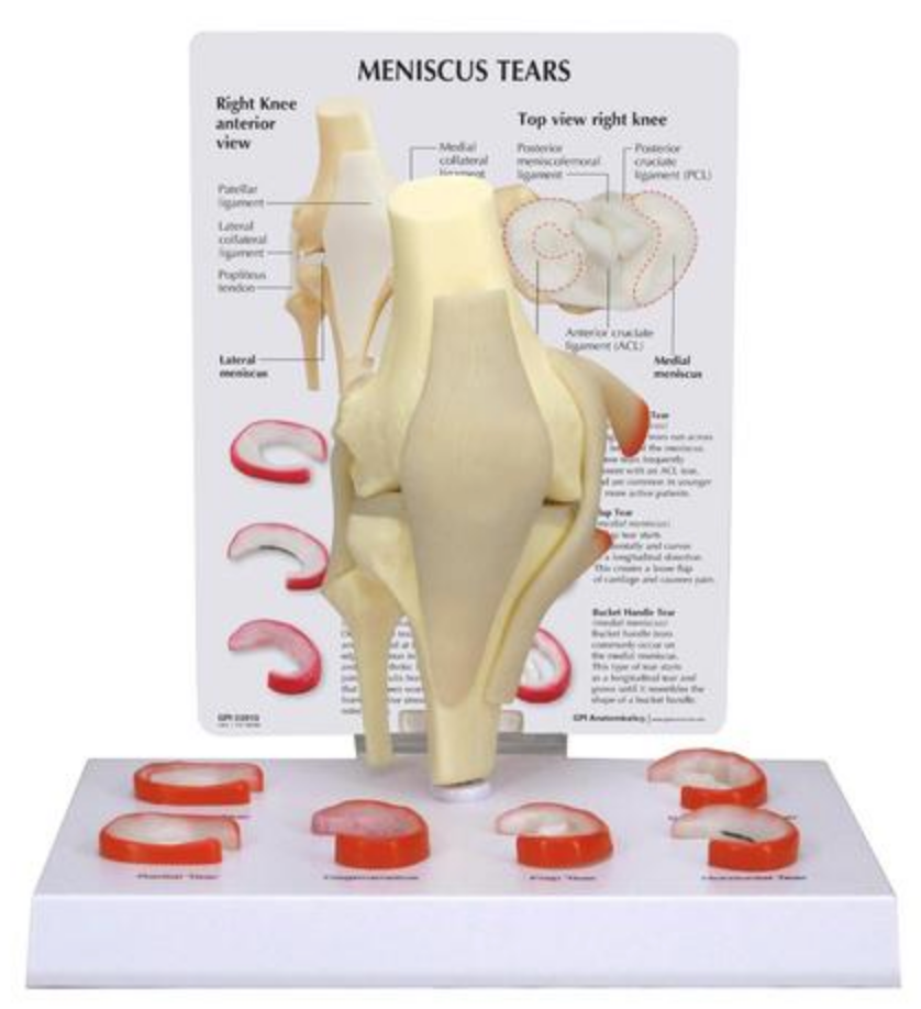 Knee model with meniscal lesions and ligaments