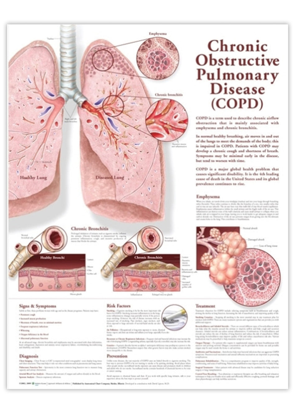 Plakat om Kronisk Obstruktiv Lungesygdom (KOL) lamineret engelsk