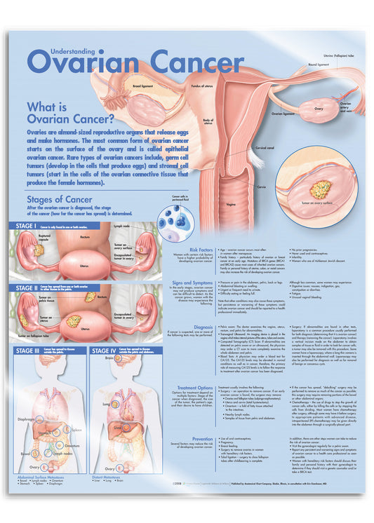 Laminated poster about ovarian cancer with text in English