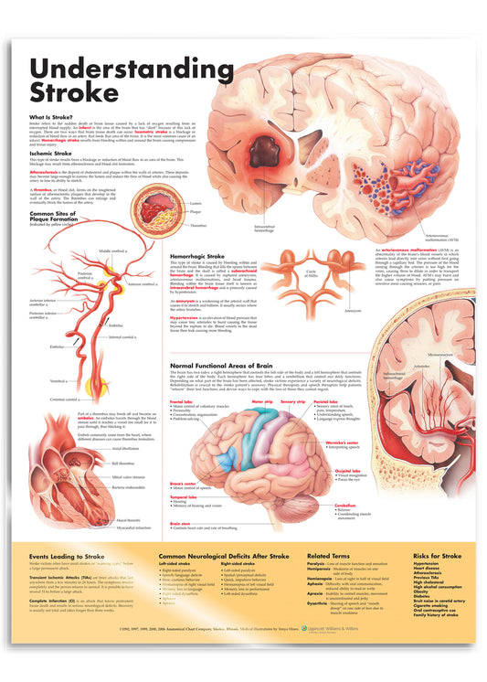 Laminated poster about stroke in English 