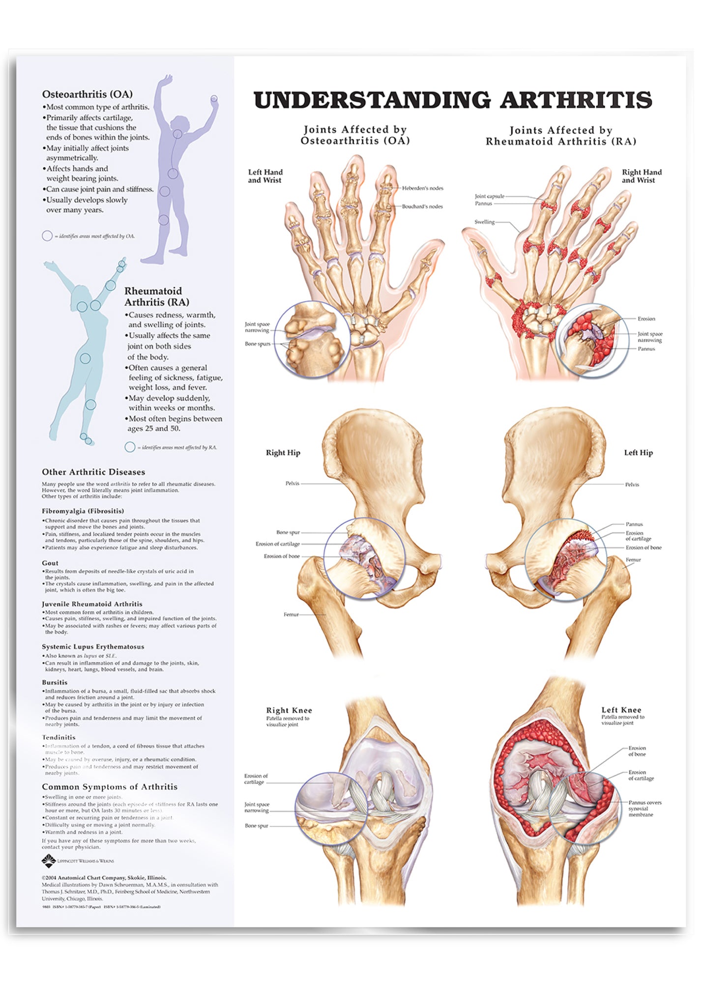 Laminated poster about arthritis in English
