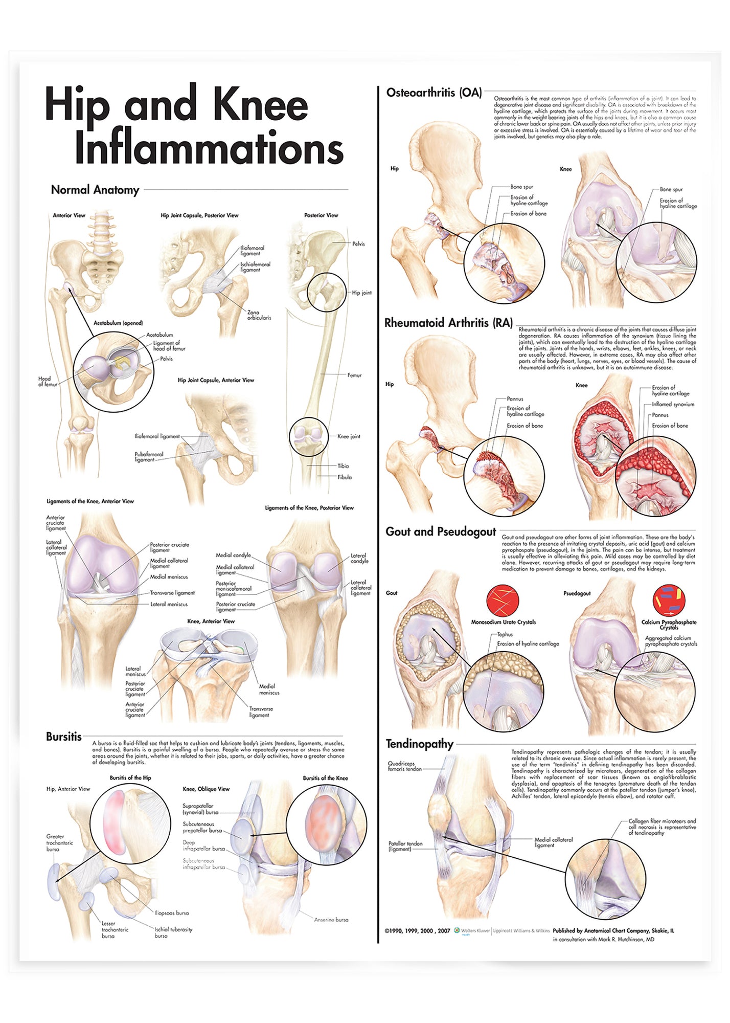 Laminated poster about inflammation of the hip &amp; knee in English 