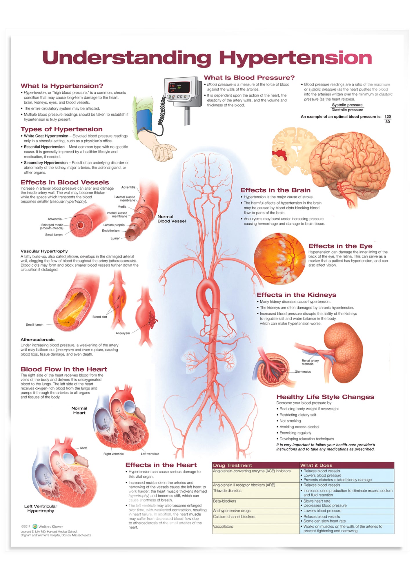 Laminated poster about high blood pressure in English 