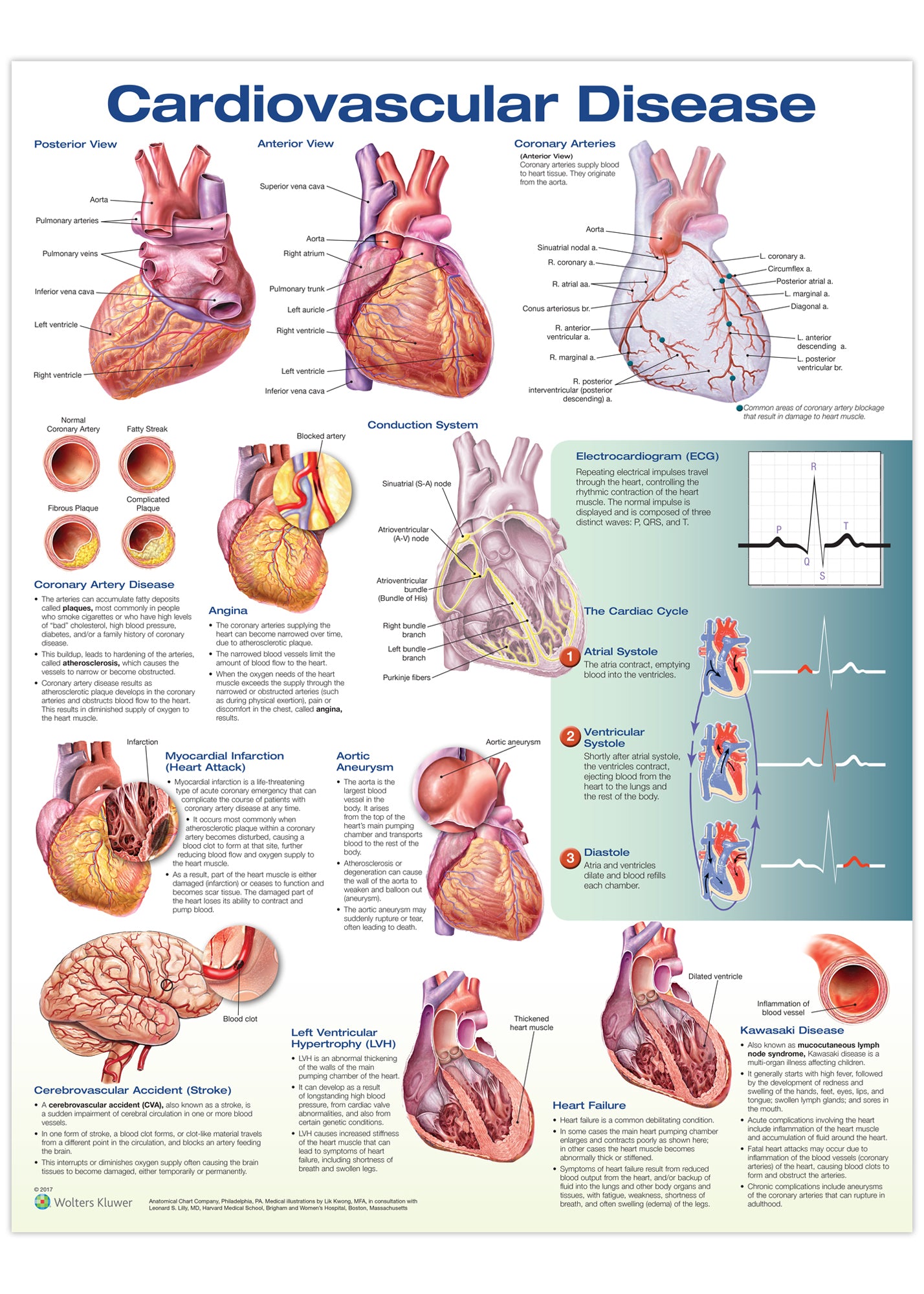 Affisch om hjärt- och kärlsjukdomar på engelska 