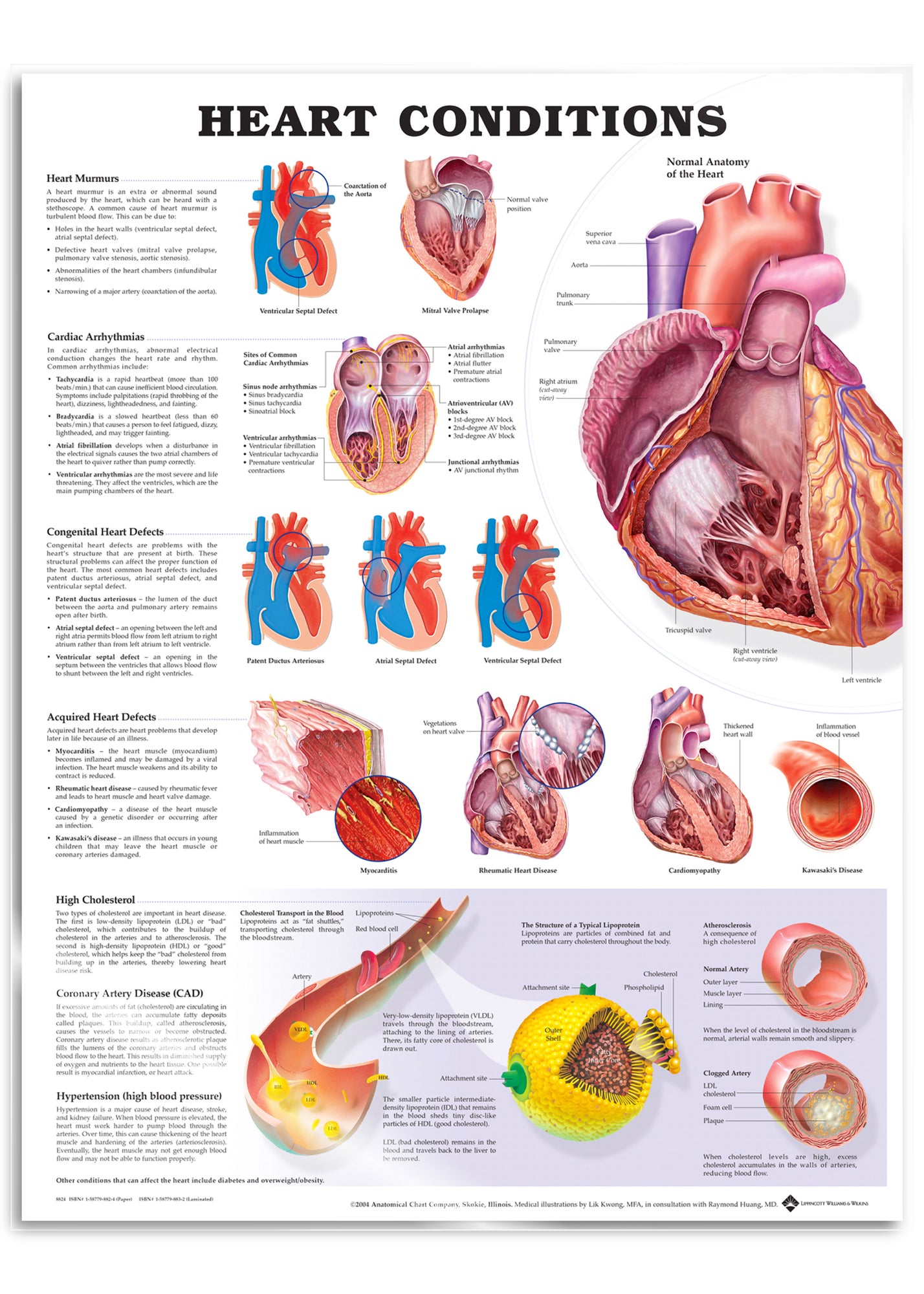 Laminated poster about heart disease in English 