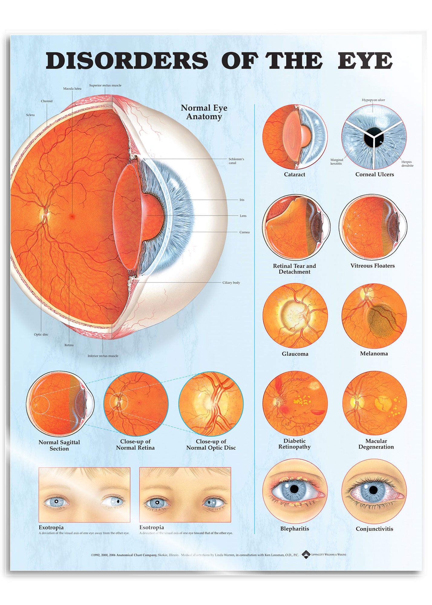 Laminated poster about eye diseases in English 