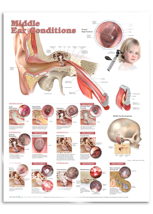 Laminated poster about diseases of the middle ear in English 