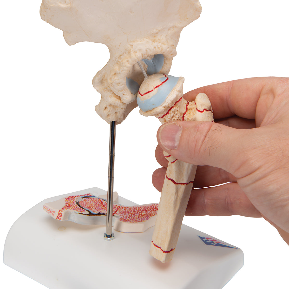 Reduced hip model with focus on hip fractures and hip osteoarthritis