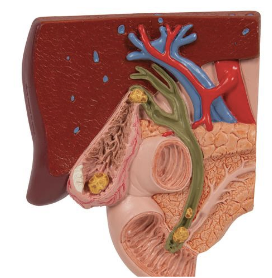 Reduced scale model of the biliary tract showing gall bladder and gallstones