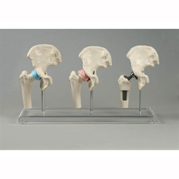 3 reduced hip models incl. hip prosthesis on stand with Plexiglas foot