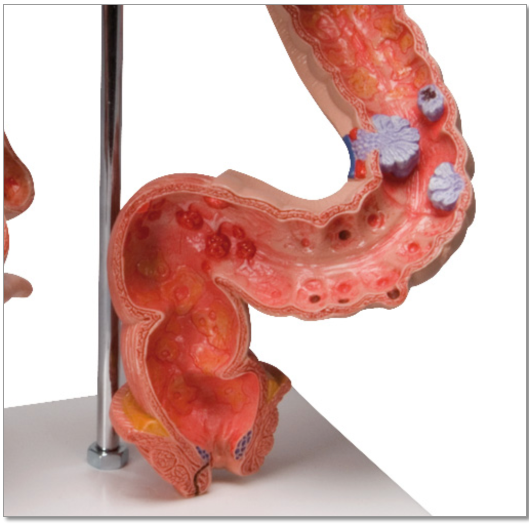Detaljerad modell av tjocktarmen som visar flera sjukdomar