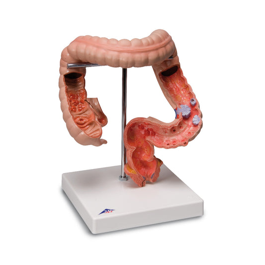 Detailed model of the colon showing several diseases