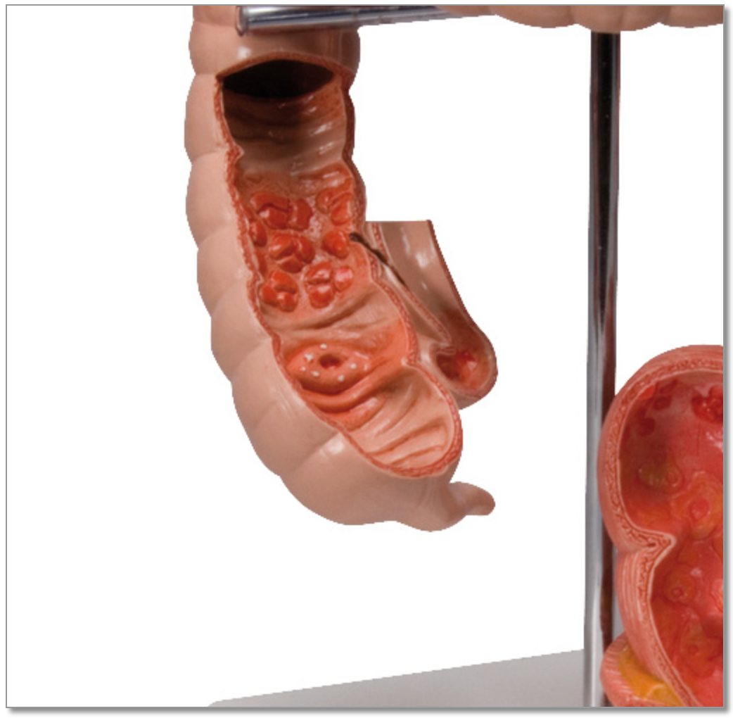 Detailed model of the colon showing several diseases