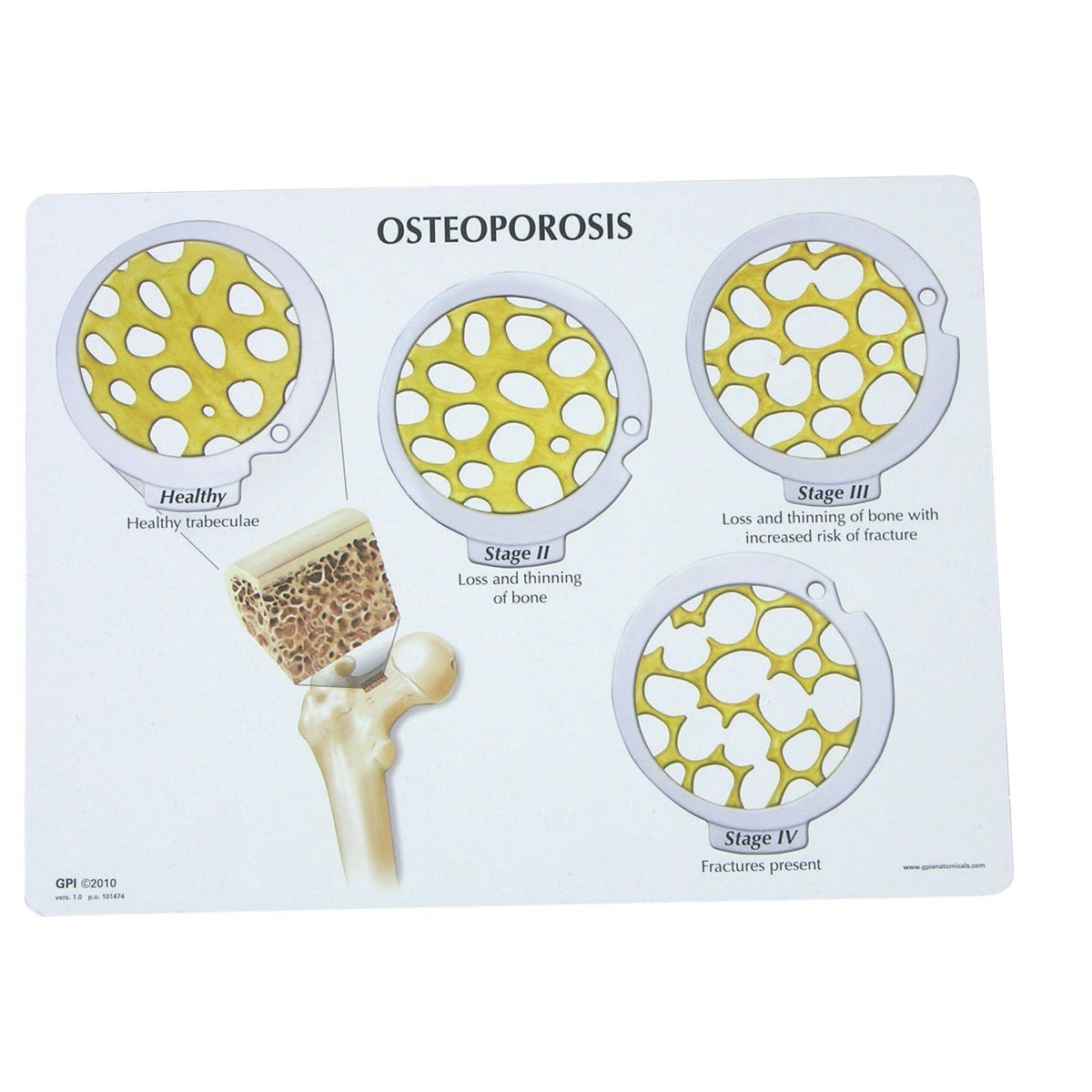 Modell av benvävnad och osteoporos i diskar