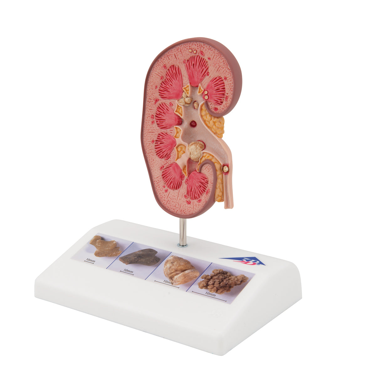 Njurmodell som visar stenar på olika ställen i njuren