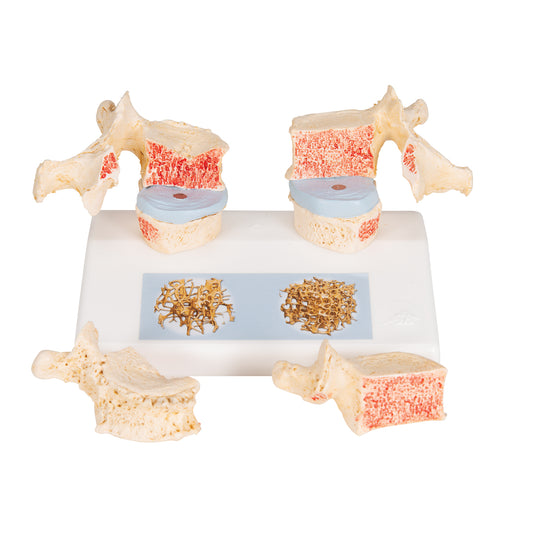 Anatomisk model af ryghvirvler, som illustrerer osteoporose vs sundt knoglevæv