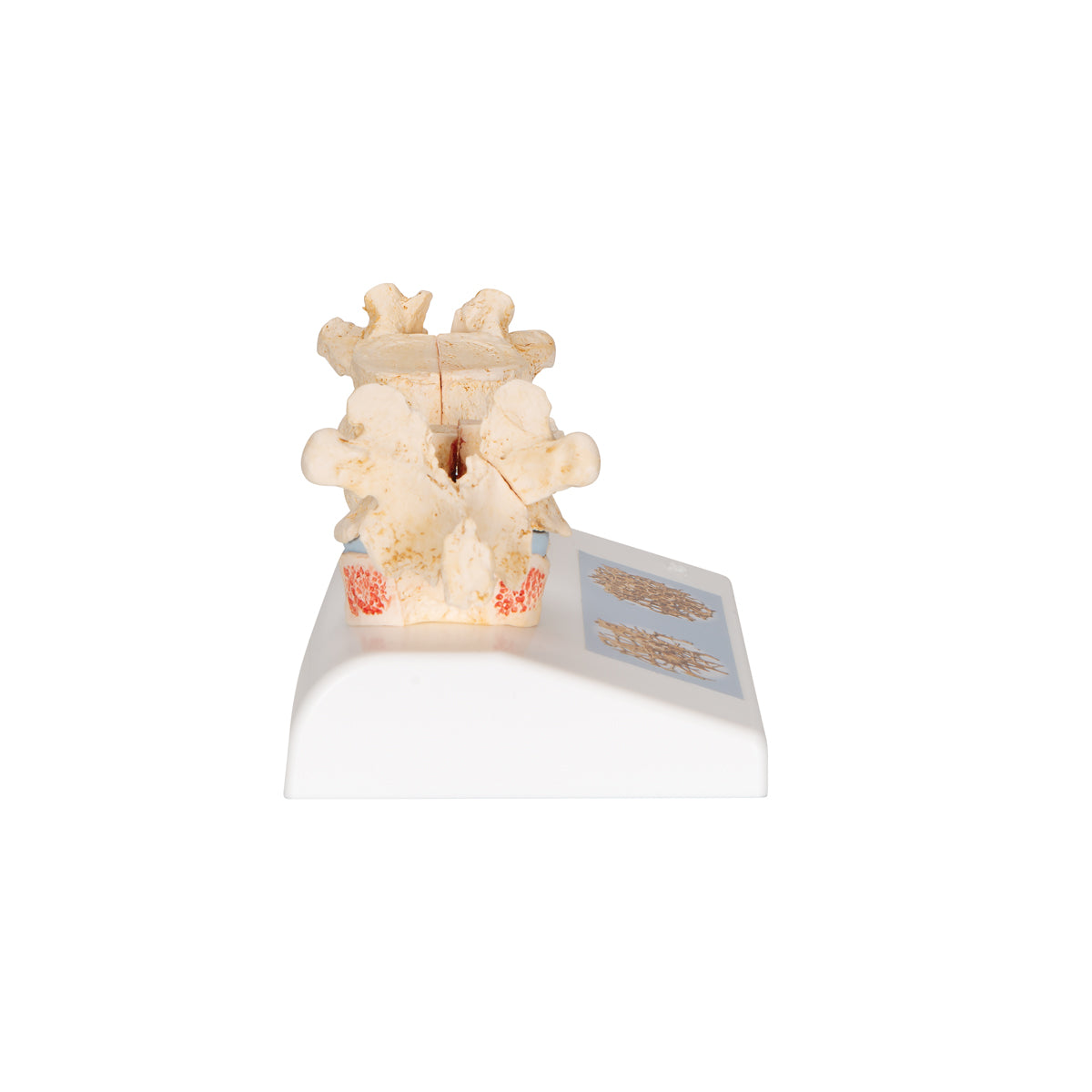 Anatomisk modell av kotor som illustrerar osteoporos vs frisk benvävnad