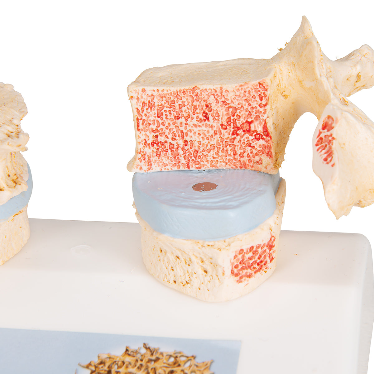 Anatomical model of vertebrae illustrating osteoporosis vs healthy bone tissue