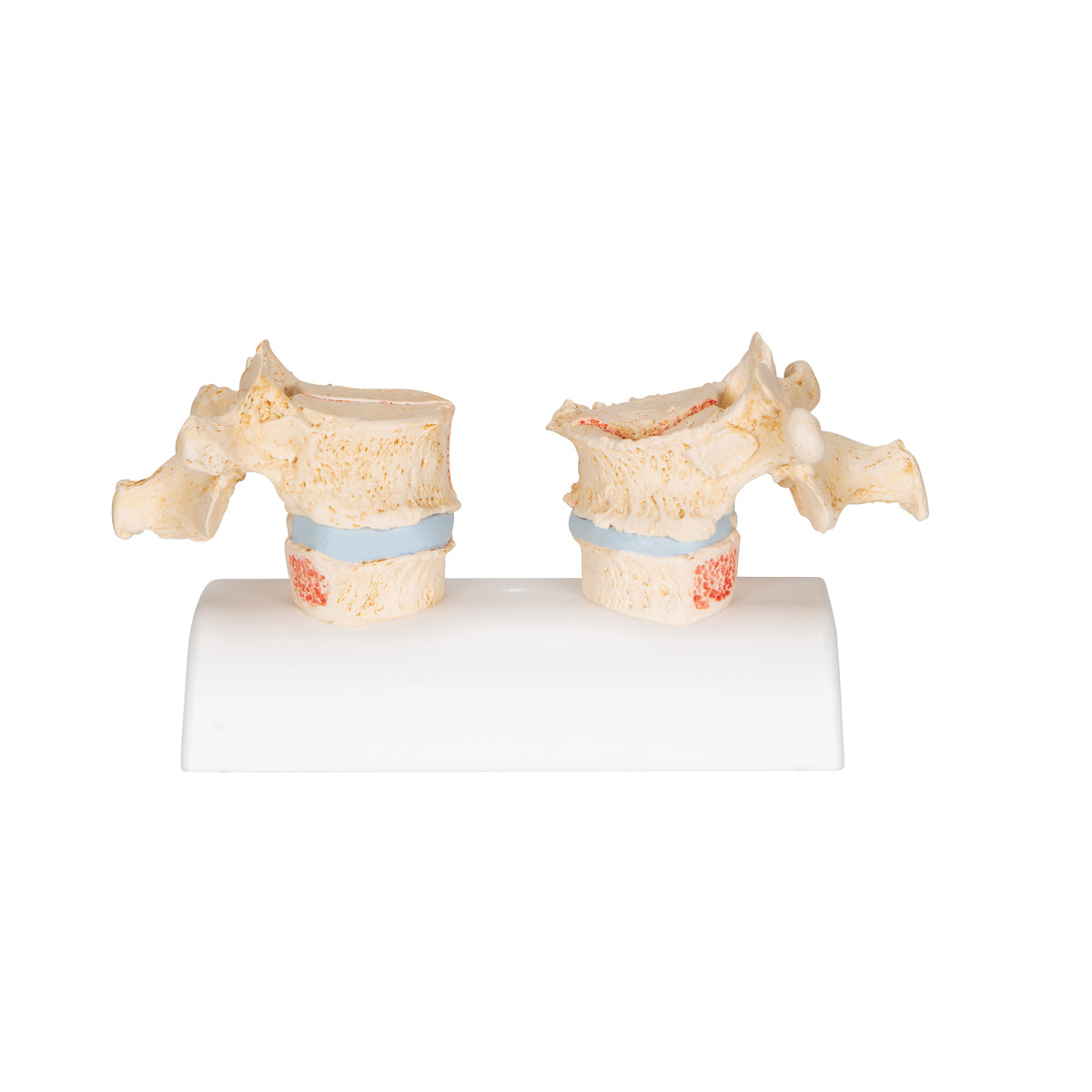 Anatomisk modell av kotor som illustrerar osteoporos vs frisk benvävnad