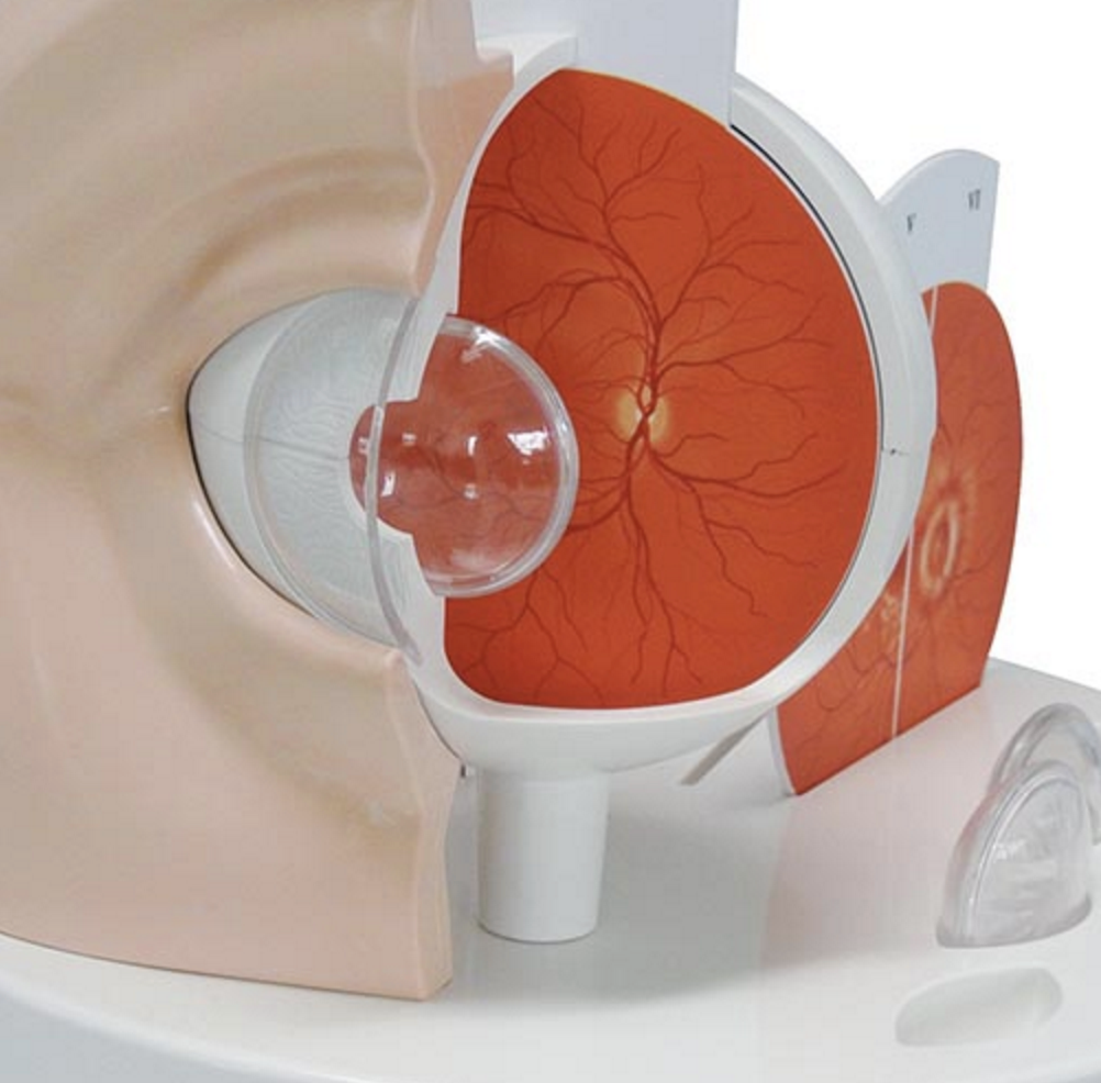 Practical eye model which is enlarged and shows 11 eye diseases/disorders