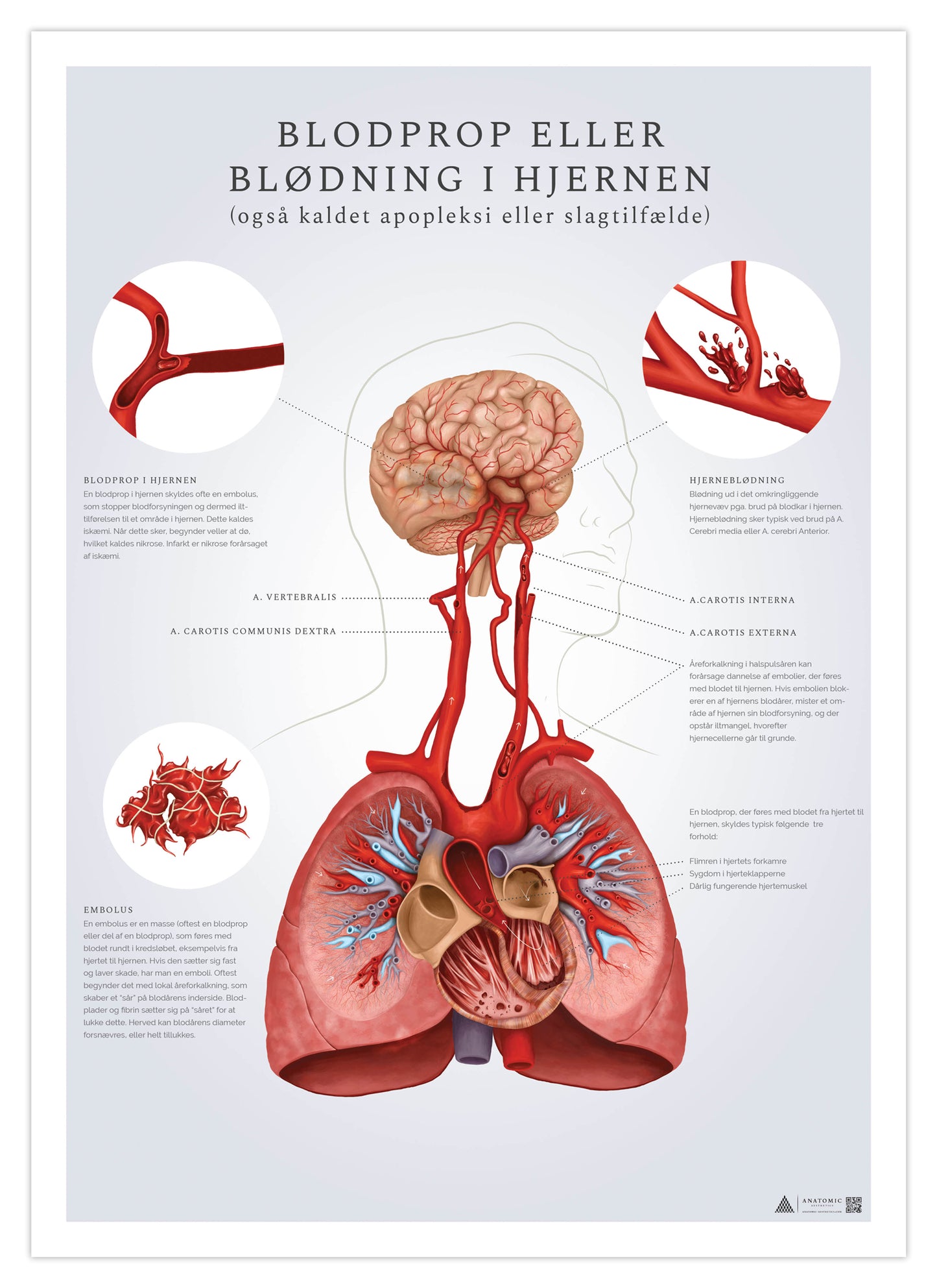Affisch med fokus på stroke (blodpropp i hjärnan och hjärnblödning)