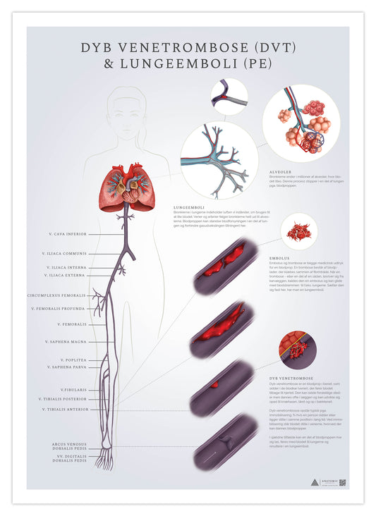 Affisch om djup ventrombos och lungemboli (DVT och PE) 