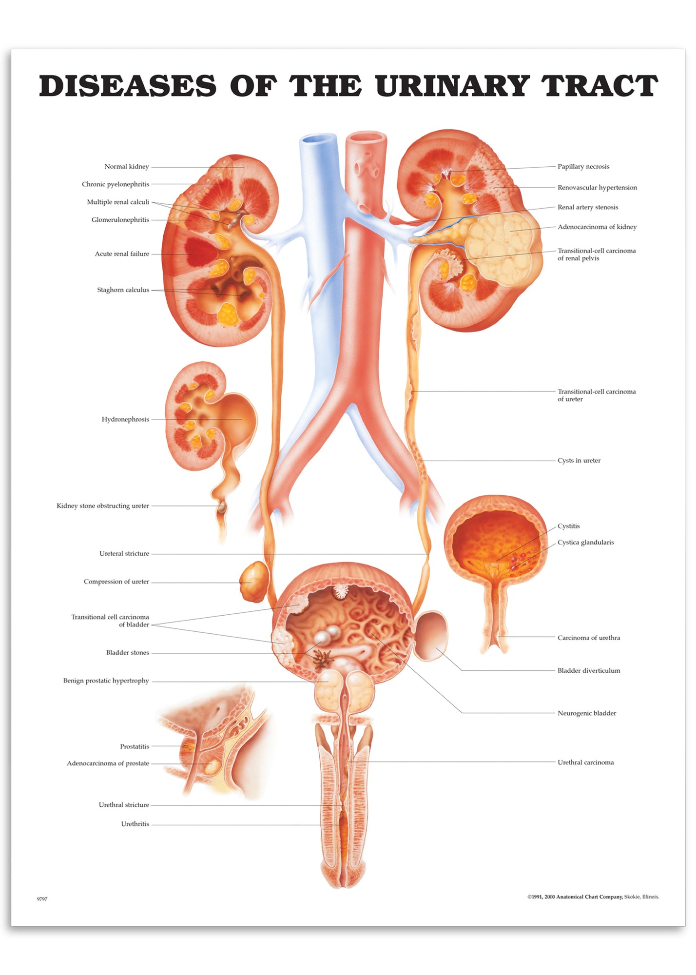 Affisch om de flesta sjukdomar i njure och urinvägar på engelska