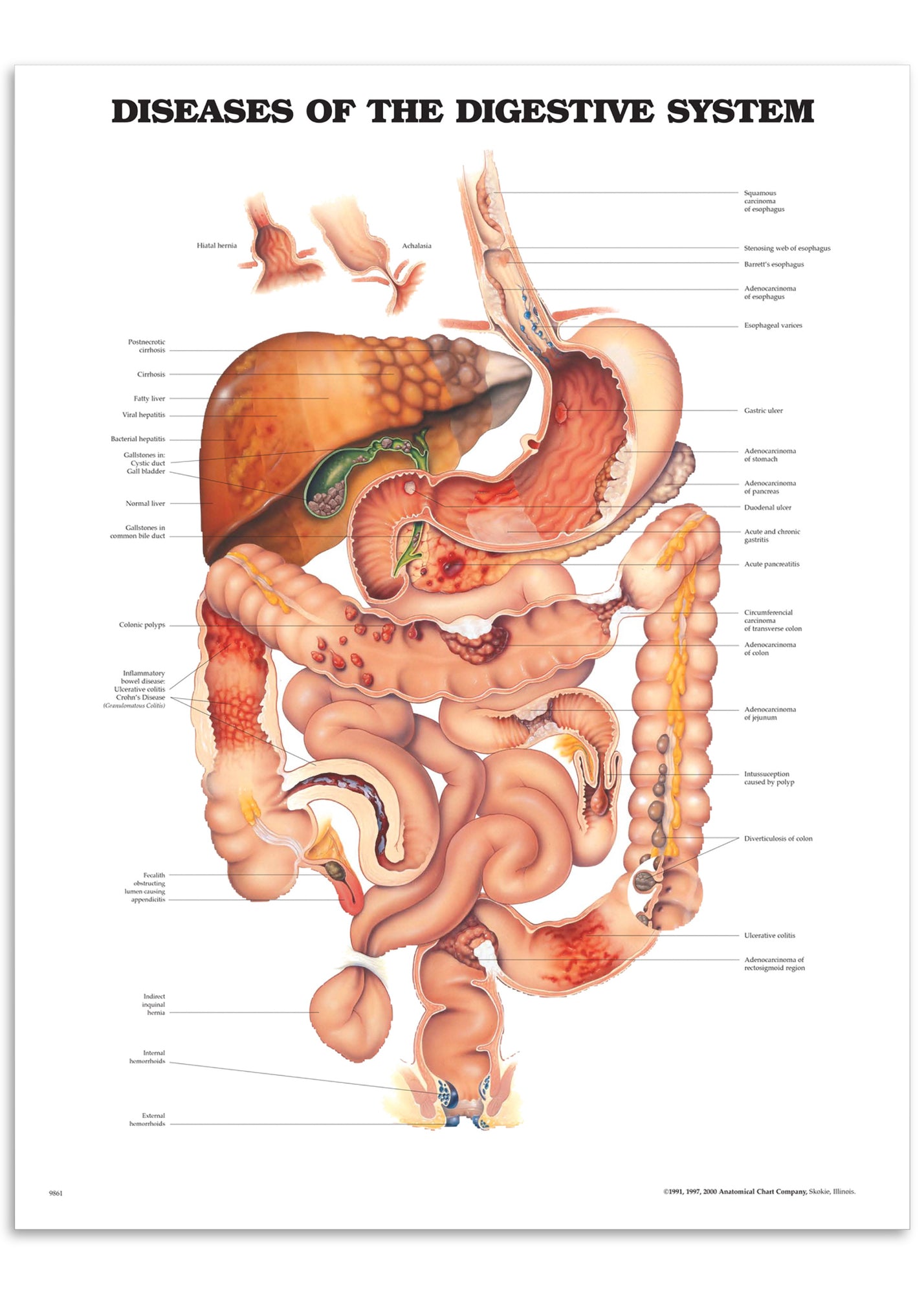 Poster about disorders of the digestive system in English 