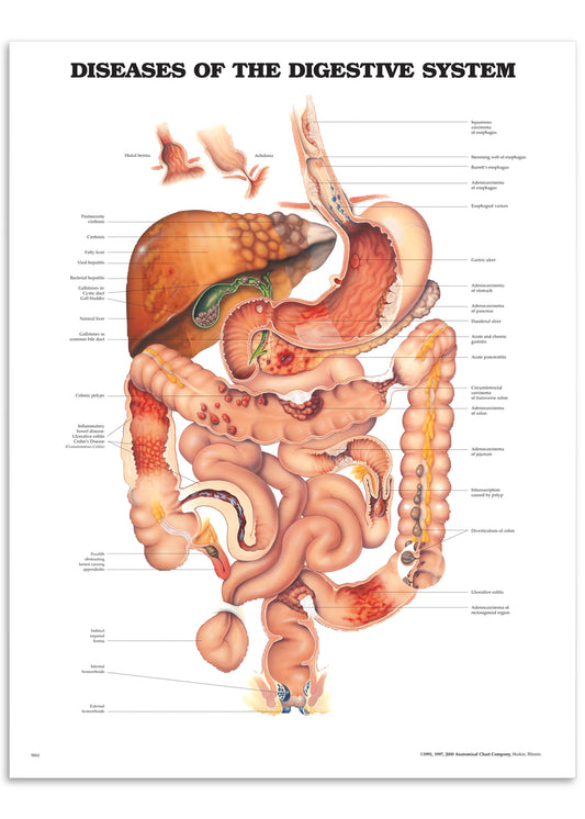 Poster about disorders of the digestive system in English 