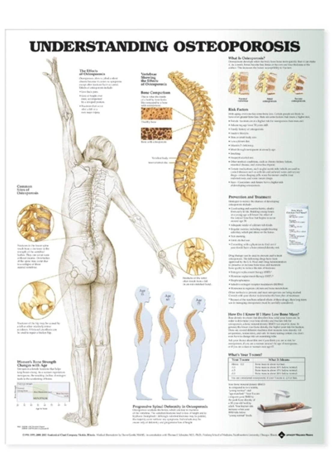 Laminated poster about osteoporosis (brittle bones) in English 