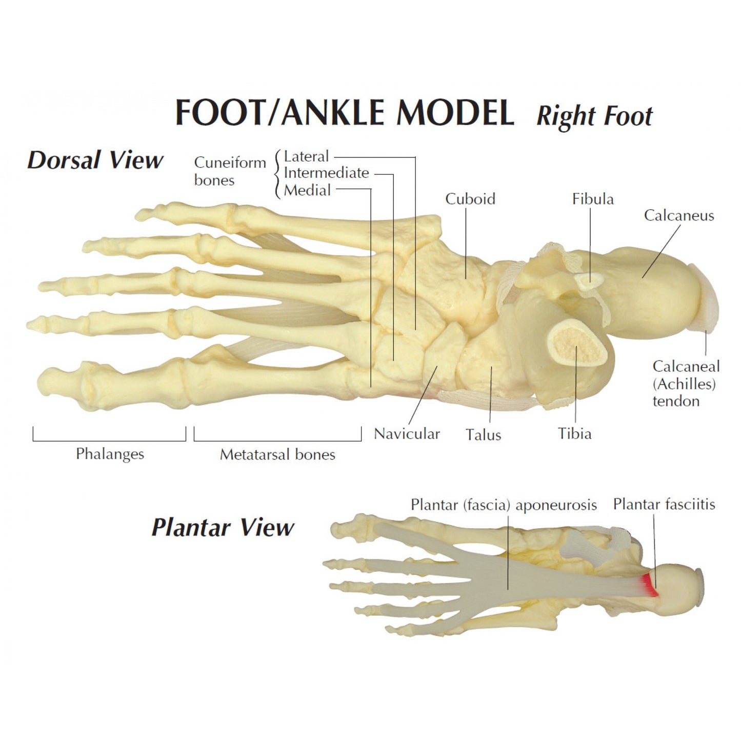 Heel spur (plantar fasciitis) foot model