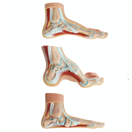 Set of 3 foot models showing a normal foot, a flat foot and a hollow foot