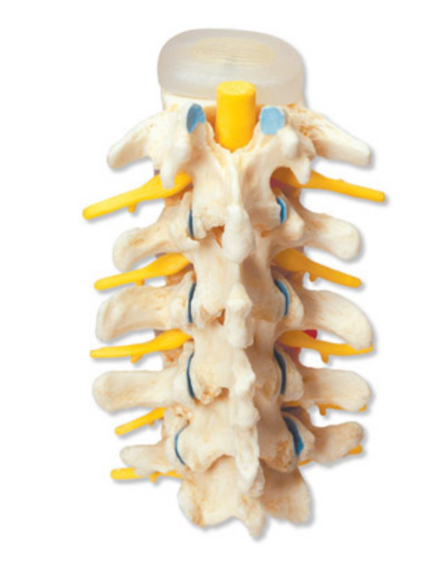 Easy-to-understand model of lumbar vertebrae with pathological conditions