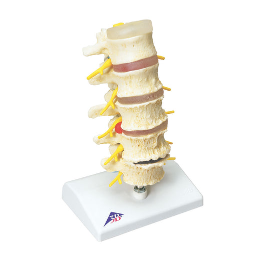Easy-to-understand model of lumbar vertebrae with pathological conditions