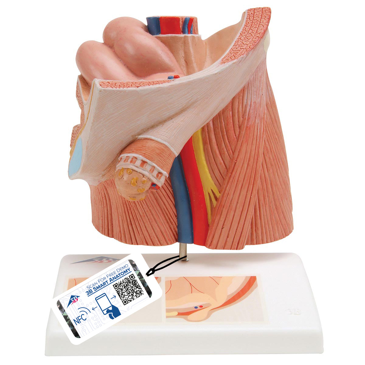 Anatomical model illustrating inguinal hernia